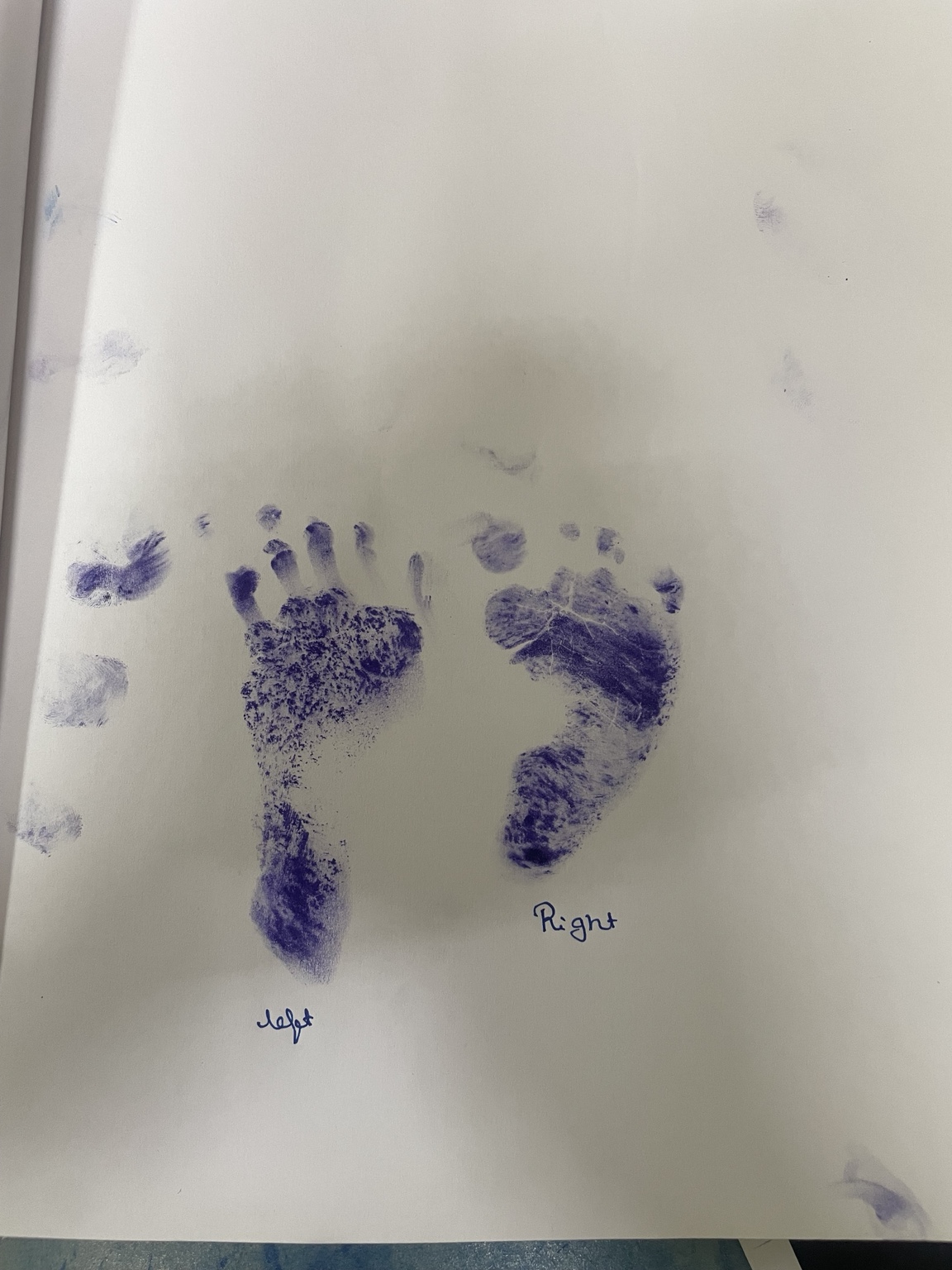 Clinical footprint assessment demonstrating altered foot contact pattern in Congenital Talipes Equinovarus clubfoot